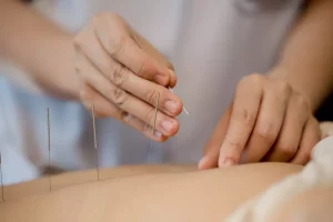 Acupuncture 9 - Wellness Center San Diego