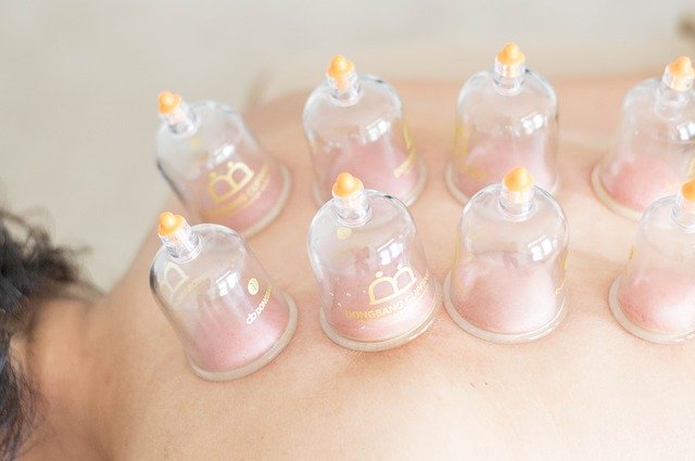 Cupping  San Diego, CA 